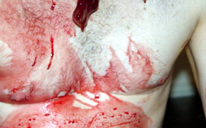 Fotos horribles de un hombre mordido por pitbull