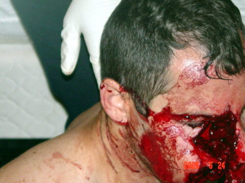 Fotos horribles de un hombre mordido por pitbull
