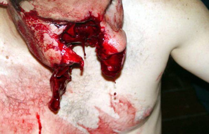 Fotos horribles de un hombre mordido por pitbull
