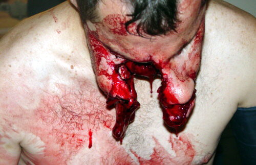 Fotos horribles de un hombre mordido por pitbull